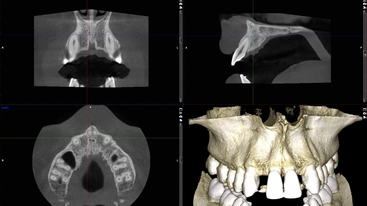 Implant planning for congenitally missing lateral incisors
