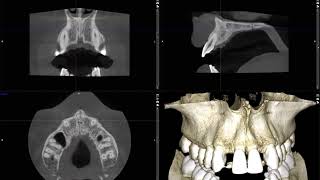Implant planning for congenitally missing lateral incisors