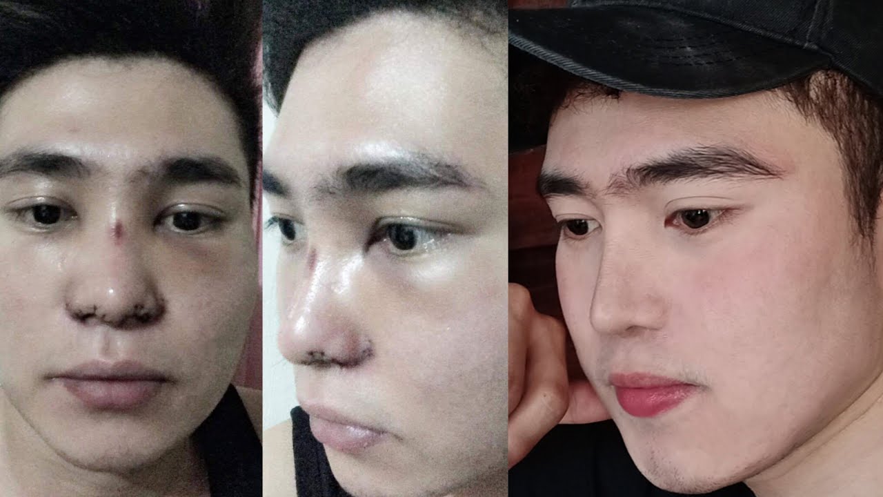 Rhinoplasty/Nose Job 3 YEARS UPDATE! Rhinoplasty