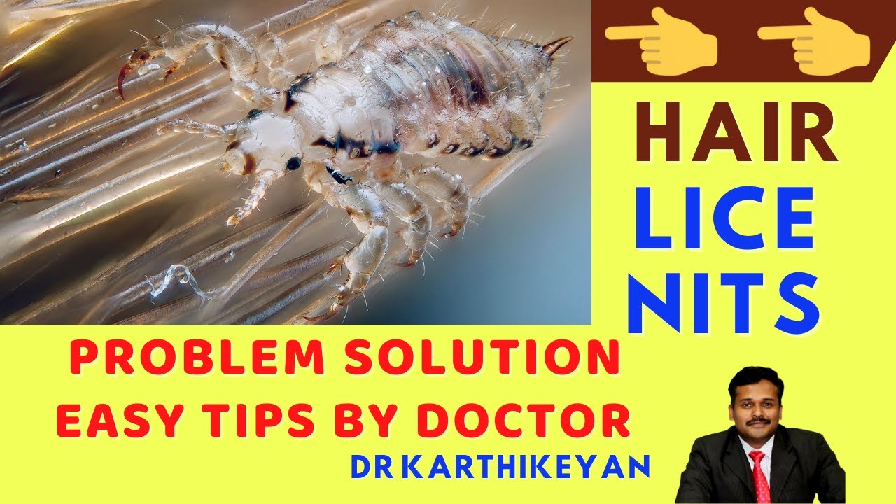 [ENGLISH] hair lice removal home remedies treatment dr karthikeyanhair lice 