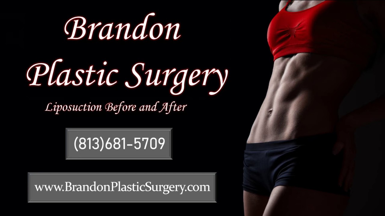 Liposuction For Belly Fat and Love Handles YouTube