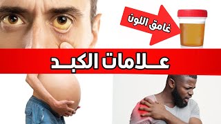 سبع علامات تحذيرية لتشمّع الكبد (مرض الكبد المتقدم)