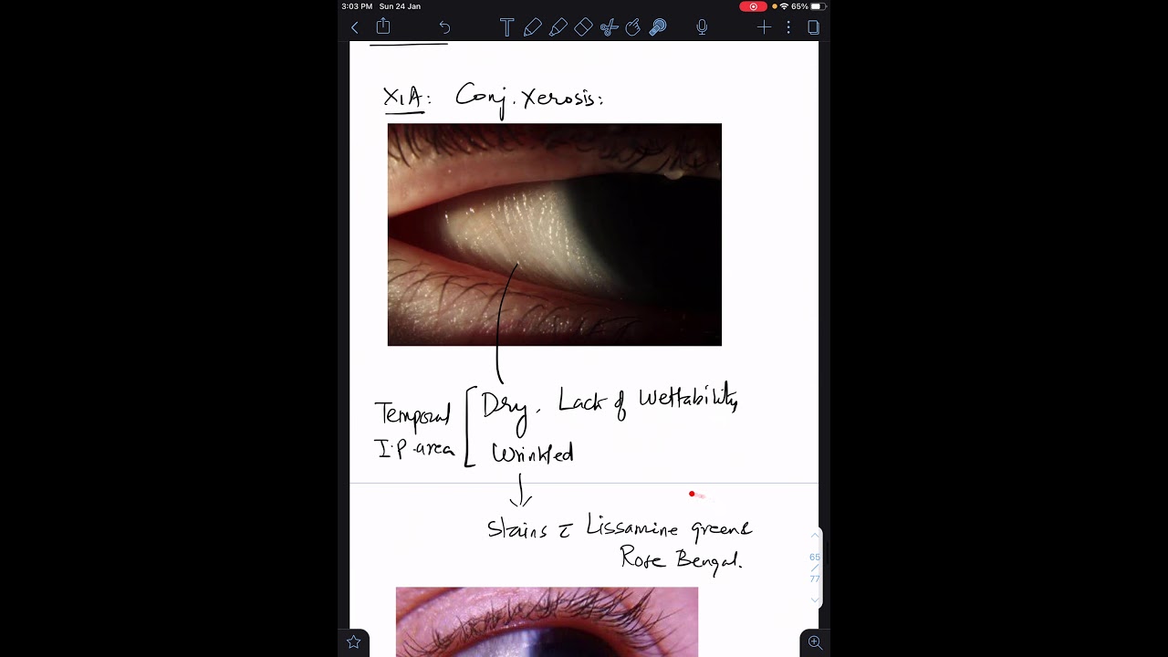 Case 7: Xerophthalmia (Vitamin A Deficiency)