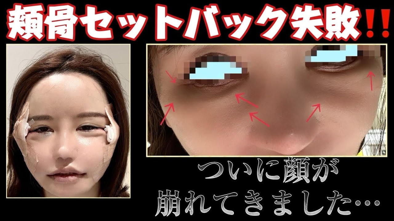 頬骨セットバック失敗して顔ぼこぼこになった😇