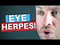 Cold Sores On Eyes! - Eye Herpes Explained (HSV)