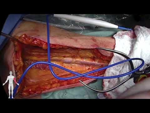 Arteriovenous Fistula Creation - Brachiobasilic Transposition (Eric Peden, MD, M. Mujeeb Zubair, MD)
