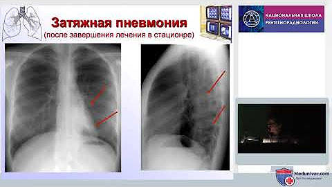 вялотекущая пневмония у взрослых. вялотекущая пневмония. диагностические критерии затяжной пневмонии. затяжная пневмония симптомы. затяжная пневмония.