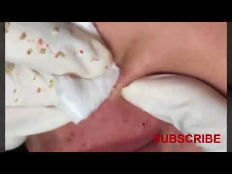 How to remove blackheads around mouth, blackhead treatment, Acne treatment,