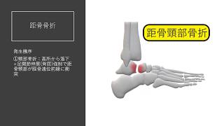 柔道整復理論　足根骨骨折(距骨・踵骨）