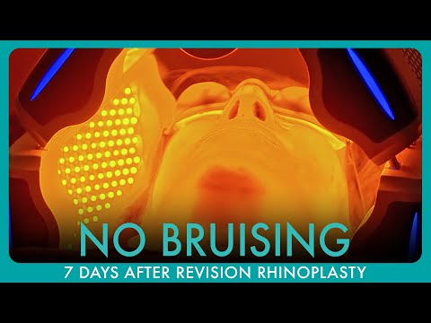 Why This Patient Had Less Pain and Bruising After Her Revision Rhinoplasty