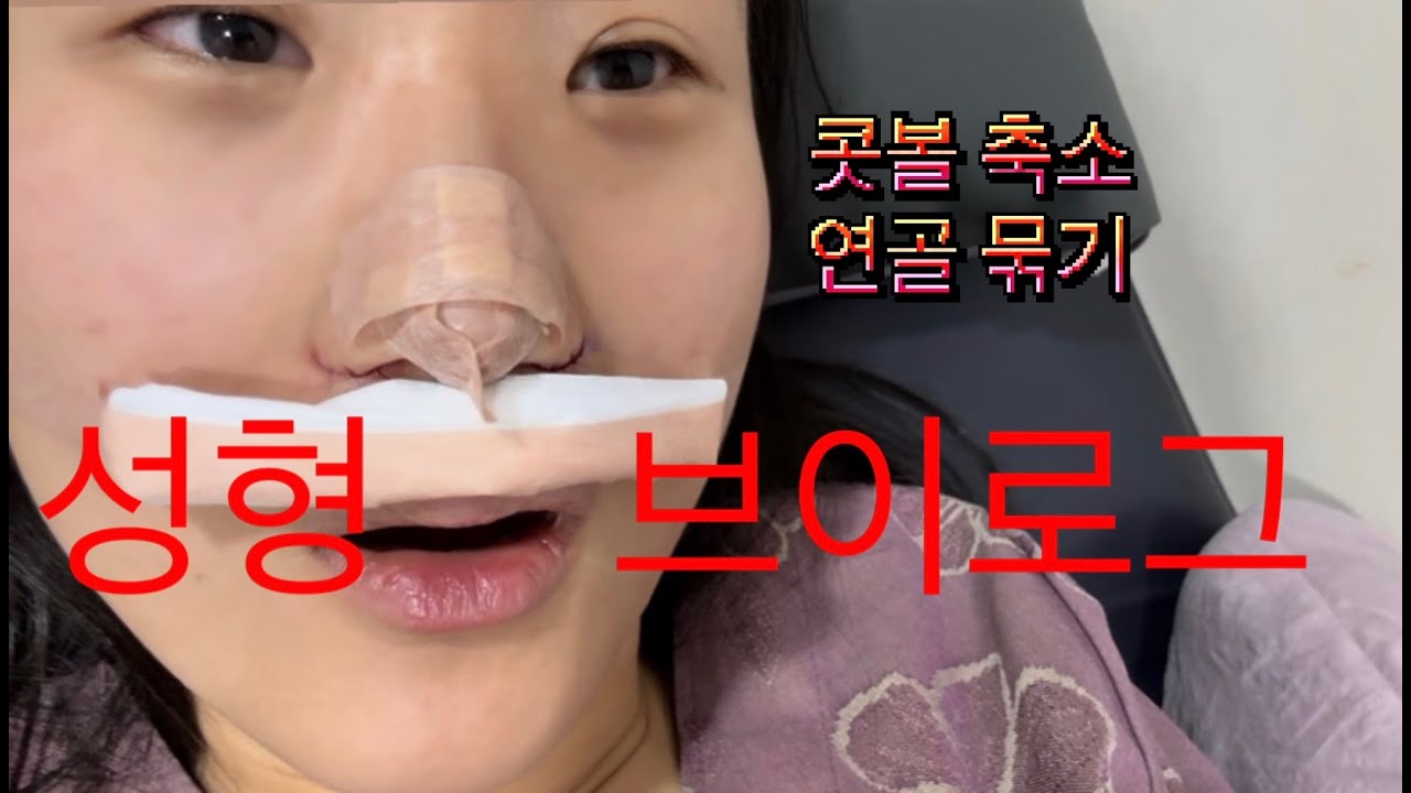 성형 브이로그 (콧볼축소&코끝연골묶기)