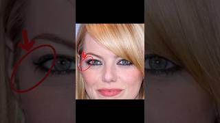 Famous Emma Stone Fox Eye or Canthopexy? #eyelidsurgery #foxeyes #plasticsurgery Net Worth