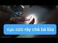 Ear wax Ráy tai khủng nhất"em bé cứng đầu không chịu ráy tai