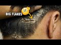 Scratching Big Flakes Psoriasis!!! Dandruff Scratching Satisfying #290