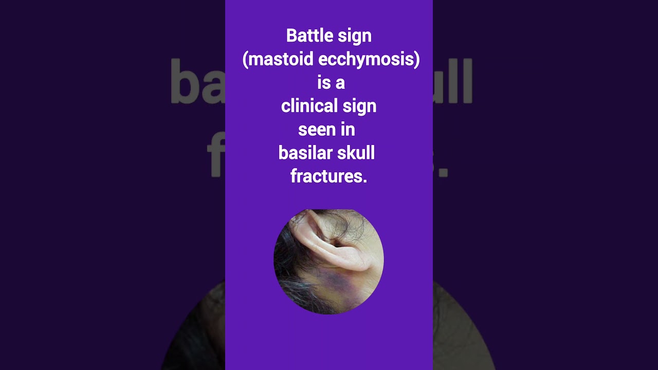 Battle Sign Seen In
