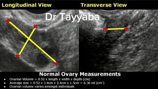 How To Measure Ovarian Volume on Ultrasound|Ovary Length, Width, Depth Measurement TAS/TVS Views USG