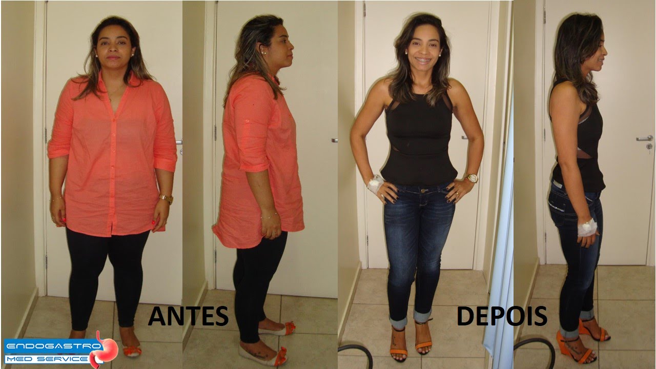 Vânia eliminou 30 Kg com o Balão Intragástrico EndogastroRio YouTube