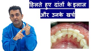 4 treatments for loose teeth and their cost!