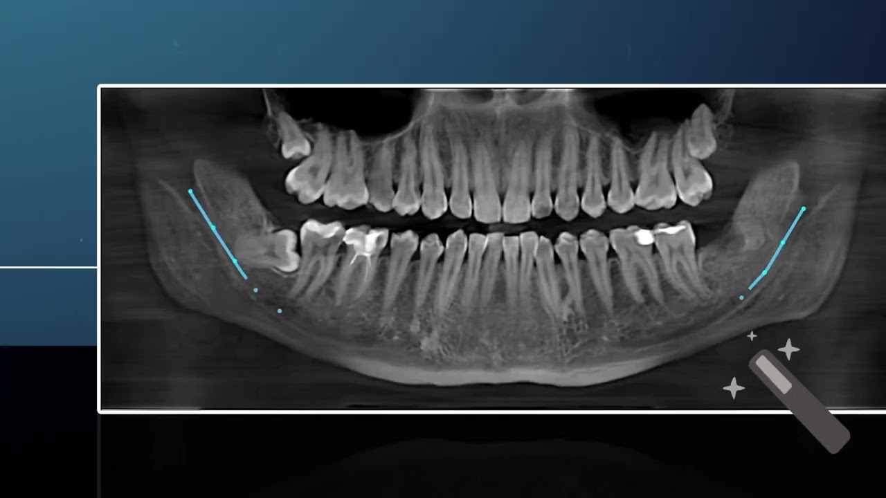 VistaSoft AI Mandibular Canal Software from Air Techniques