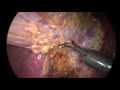 Laparoscopic cholecystectomy, difficult Calot’s triangle &amp; thin wall.