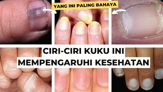 Kondisi Kuku Seperti Ini, Bisa Jadi Tanda Penyakit!