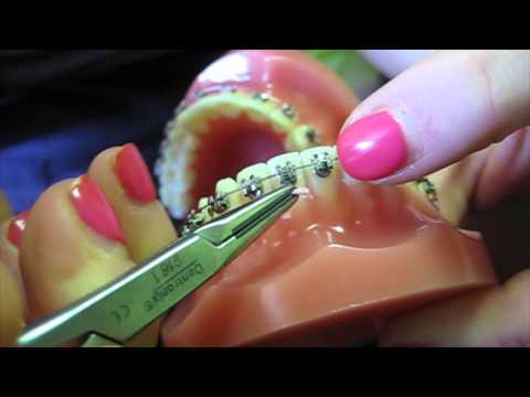 Braces 101