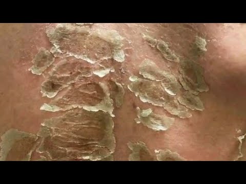 تقشير الجسم كيميائيا مستحيل تصدق ما تراه عينيك