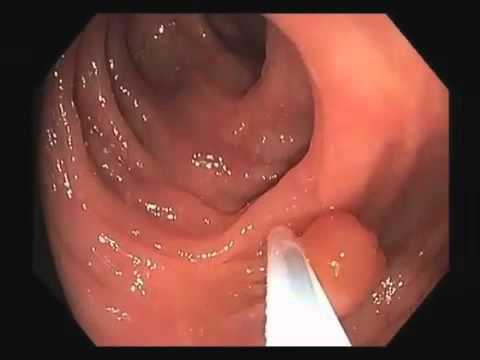 Colonoscopy Video Tour: Removal of a Colon Polyp (Polypectomy)