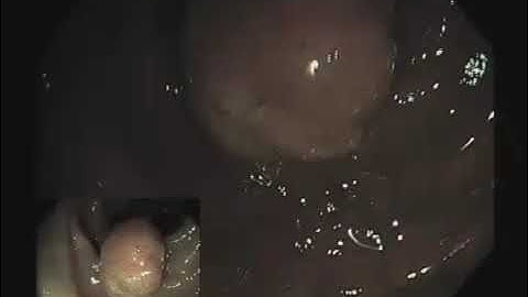 Colonoscopy Video Tour: Removal of a Colon Polyp (Polypectomy)