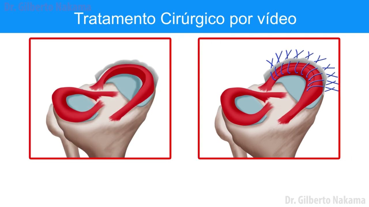 CIRURGIA POR VIDEOARTROSCOPIA NO REPARO / SUTURA DE LESÃO EM ALÇA DE ...