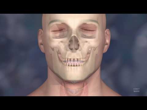 Animation of Face Transplant at the Mayo Clinic