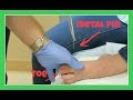 DR PULLS METAL PIN OUT OF KATIE'S TOE | Flippin' Katie