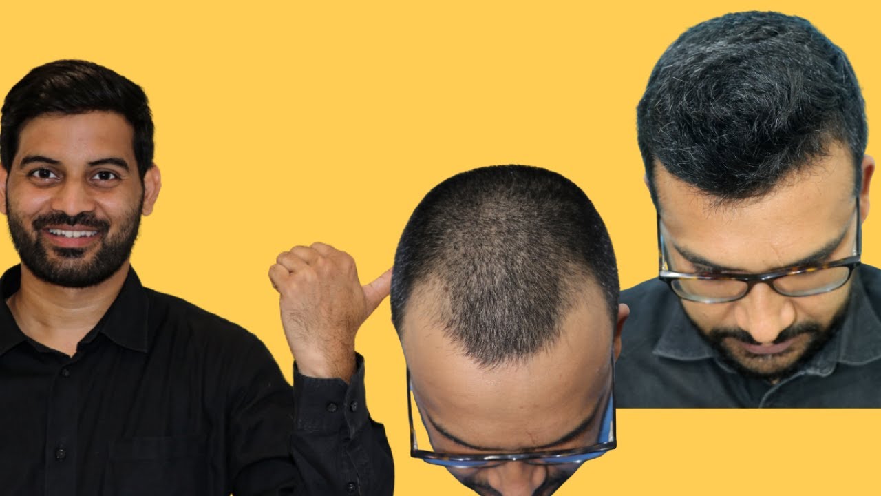 Update more than 83 hair transplant cost navi mumbai best in.eteachers