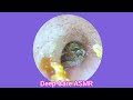 ASMR Ear Cleaning | Guaranteed Tingles and Instant Relaxation