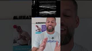 The BEST REAL TIME test for Heart Attack and Stroke risk #hearthealth #stroke #functionalmedicine