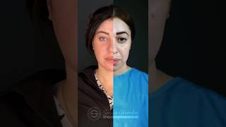 Scarless Ghoraba Facelift شد الوجه بالمنظار #beauty #bestplasticsurgeon #facelift