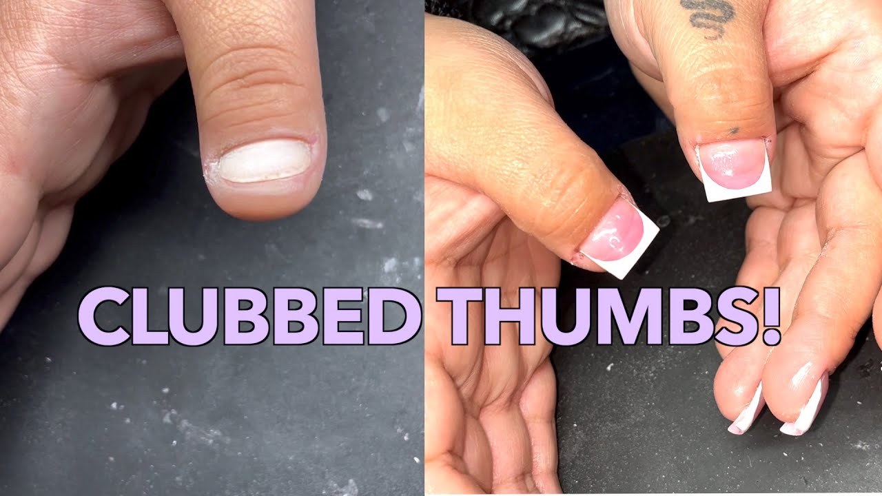 ACRYLIC NAILS ON CLUBBED THUMBS! |WIDE NAIL BEDS - YouTube