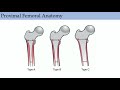 Primary hip replacement  abos orthopedic surgery board exam review