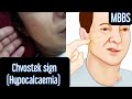 Chvostek sign seen in Hypocalcaemia #mbbs #medicine #neet #neetpg#usmle #aiims #inicet