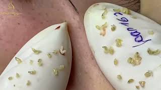 Loan Nguyen Acne Treatment speacal 5