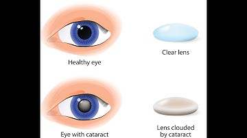 Cataract surgery CPT codes - simplify medical coding
