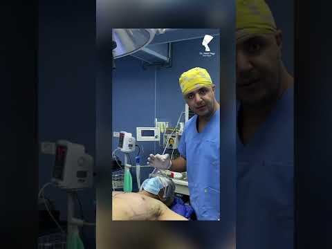 شكل منطقة الصدر قبل وبعد عملية التثدي ومكان الجرح دكتور نبيل ناجي