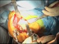 Reverse total shoulder arthroplasty (shoulder replacement) video