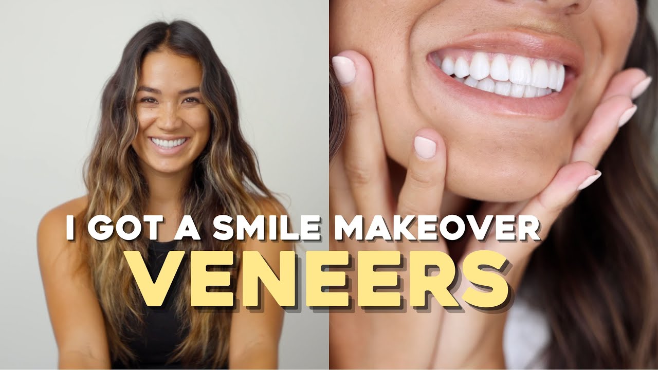 WHAT IT’S REALLY LIKE TO GET VENEERS pain, cost, regrets?? YouTube