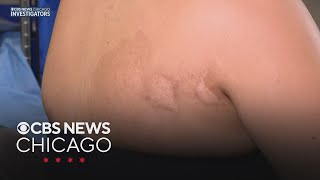 With Fourth of July comes surge in fireworks injuries; doctor urge caution and care