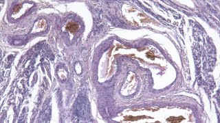 Immunotherapy research leads to promising endometrial cancer treatment at Ohio State