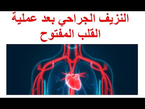 سؤال و جواب ما هي اسباب النزيف الجراحي بعد عملية القلب المفتوح متي يحتاج المريض الى استكشاف الجرح