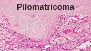 Pilomatricoma (Calcifying Epithelioma of Malherbe) - Pathology mini tutorial