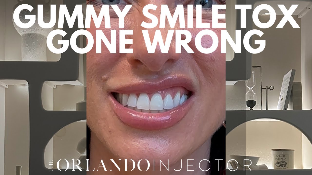 GUMMY SMILE BOTOX GONE WRONG