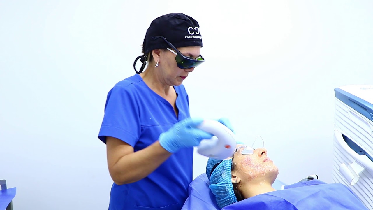 Tratamiento con Láser IPL para Cicatrices de acné Clínica